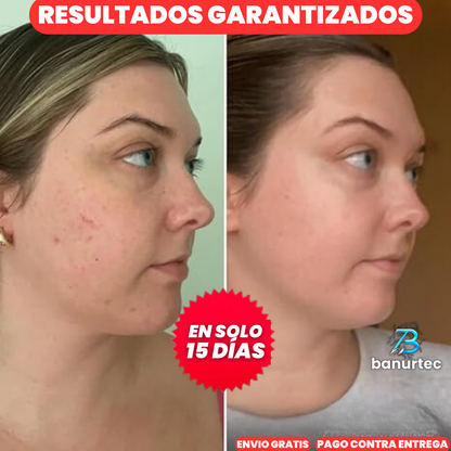 Niaglow S10™ | Serum Anti Acné Ultra Concentrado con Ácido Salicílico
