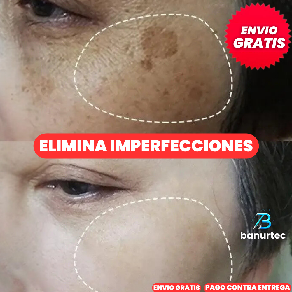 Niaglow S10™ | Serum Anti Acné Ultra Concentrado con Ácido Salicílico