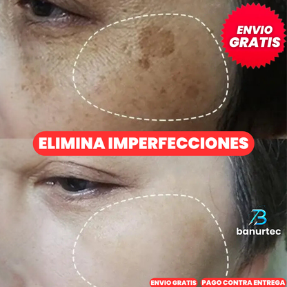 Niaglow S10™ | Serum Anti Acné Ultra Concentrado con Ácido Salicílico