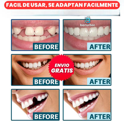 Carillas Dentales Ajustables, Dientes de Cerámica | Snapon Smile™